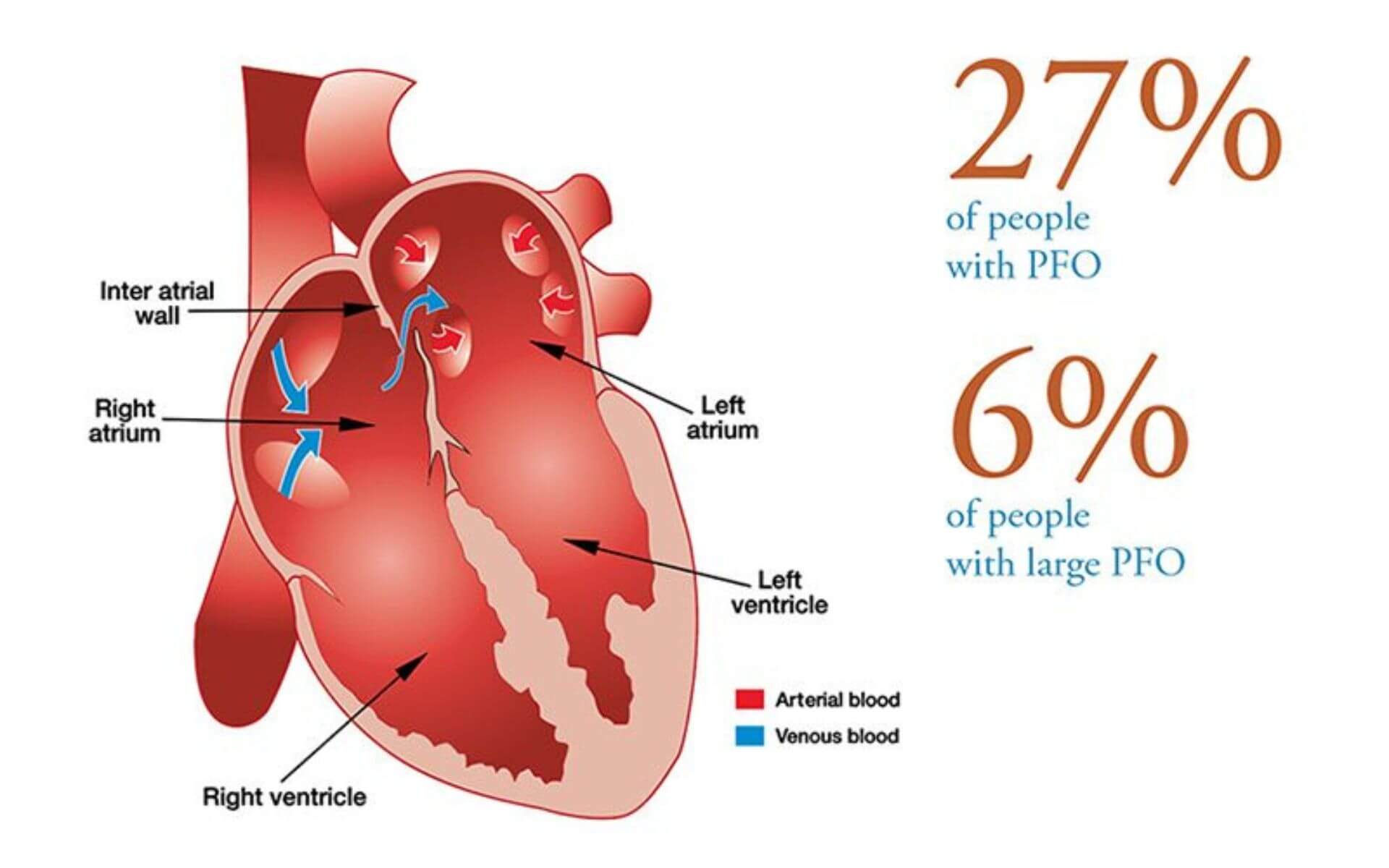 Understanding Patent Foramen